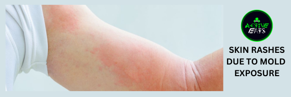Photograph displaying skin rashes caused by exposure to mold. The rashes appear as red, itchy, and inflamed patches on the skin, emphasizing the dermatological effects of mold exposure.