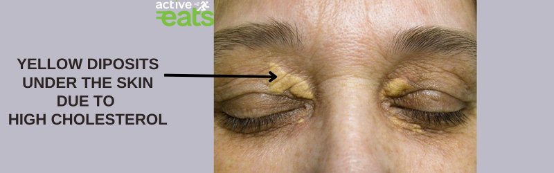 Yellow deposits known as xanthomas under eyes due to high cholesterol levels.