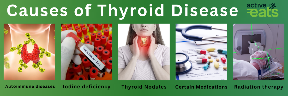 picture showing the common causes of thyroid disease which are radiation therapy, thyroid nodules, iodine deficiency, certain medications or auto immune disease.