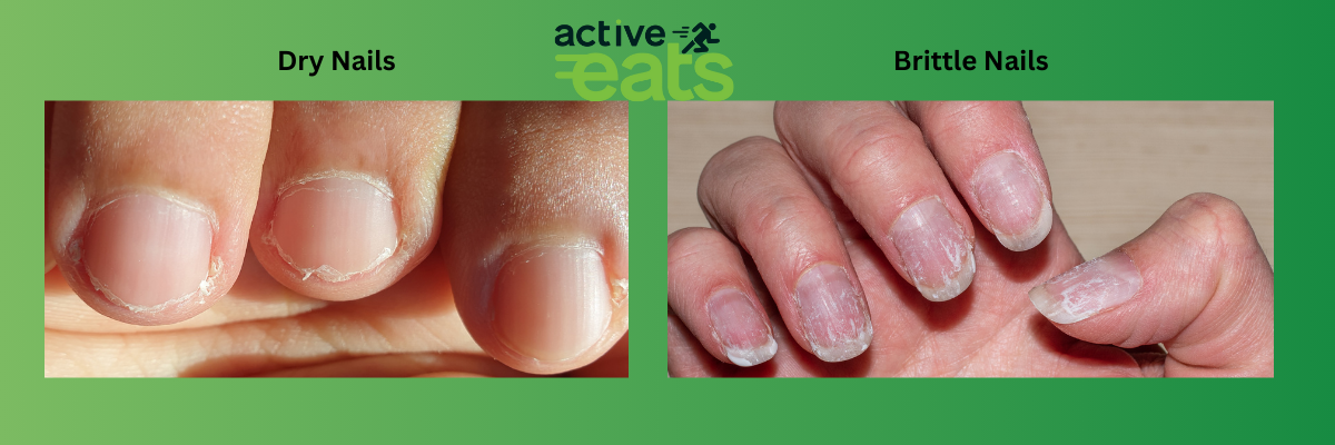 image shows dry finger nails and brittle finger nails.
