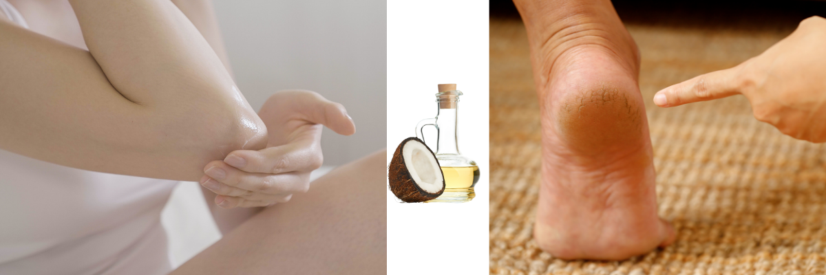  image showing Coconut Oil for rough Heel and dry Elbow